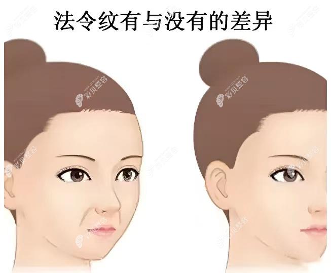 注射玻尿酸后的法令纹形态