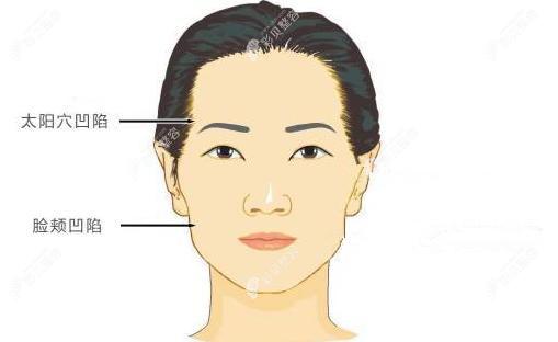爱贝芙可以填充法令纹外还有改善太阳穴凹陷这些部位